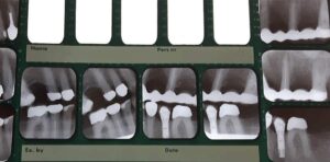Röntgenbild av tänder. Foto: Monica Atterberg