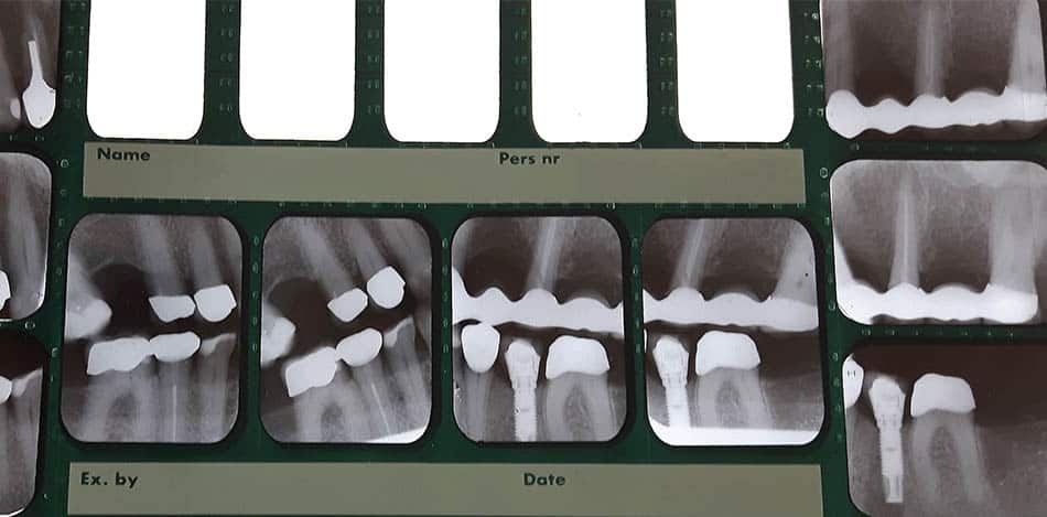Röntgenbild av tänder. Foto: Monica Atterberg
