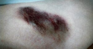 En bild på en blåslagen arm. Ungefär så här kände sig Yousef efter att ha blivit misshandlad av polis och rektor i sitt hemland Turkiet.